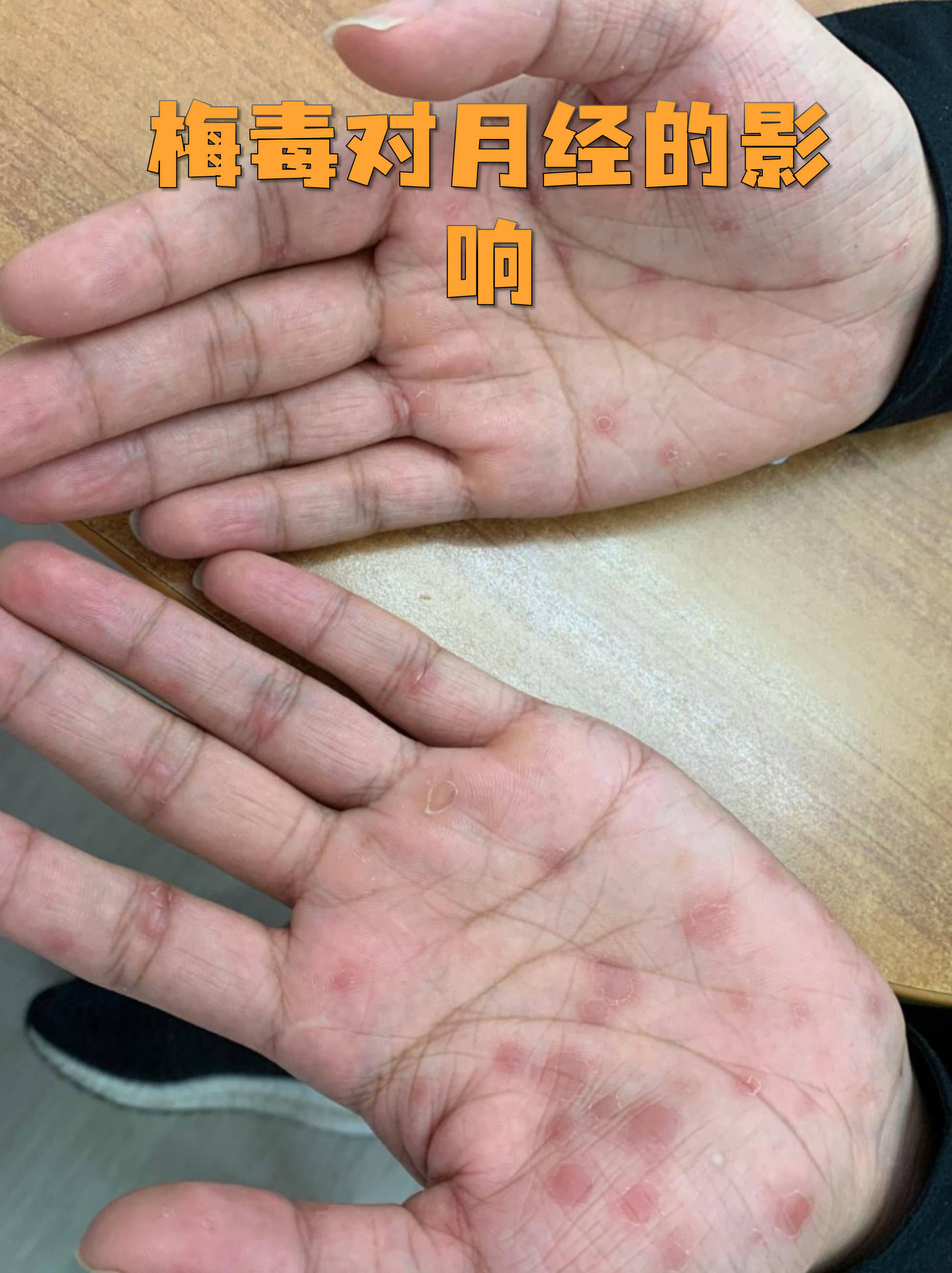 “上海现奥密克戎BA.5.2.1感染者” 南京奥密克戎？