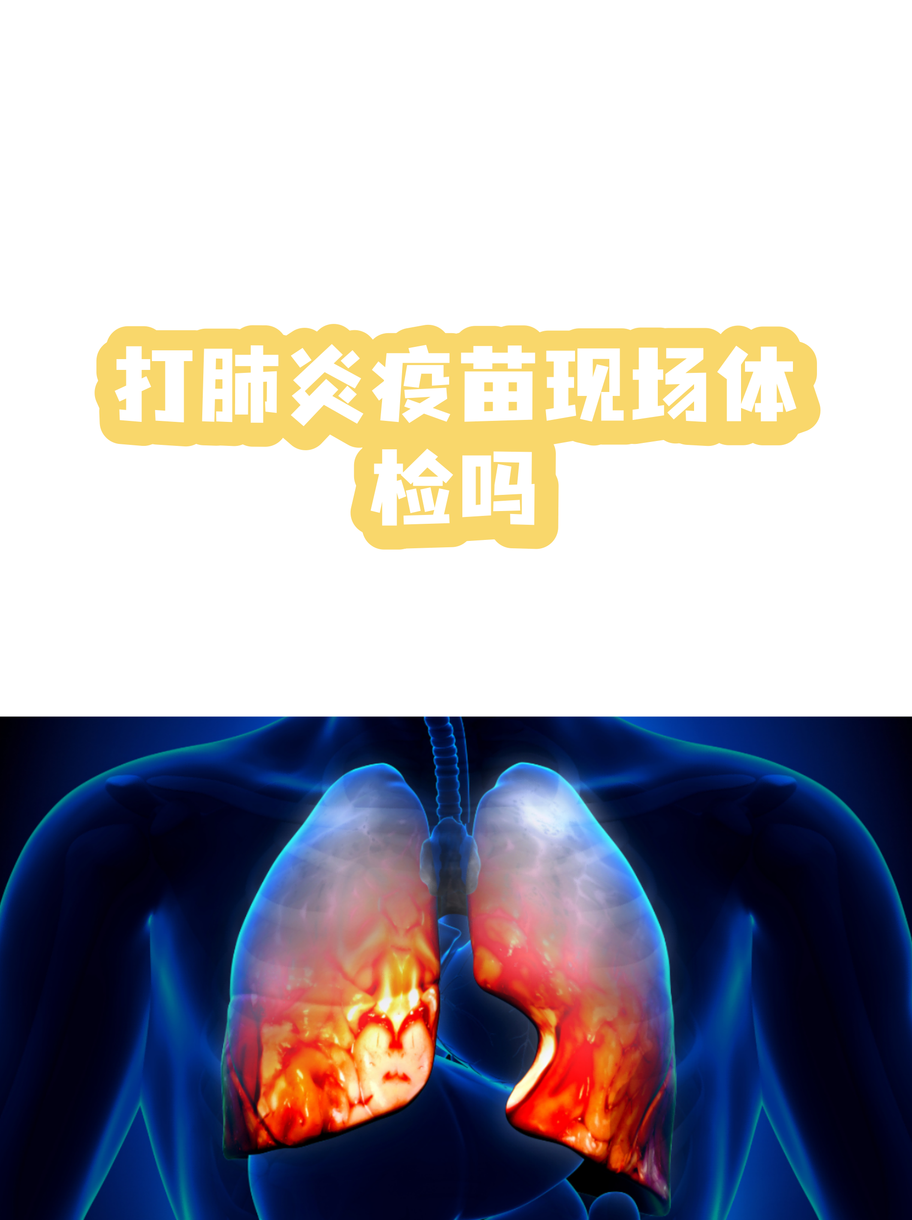 重庆肺炎︰(重庆肺炎疫苗哪里可以打)